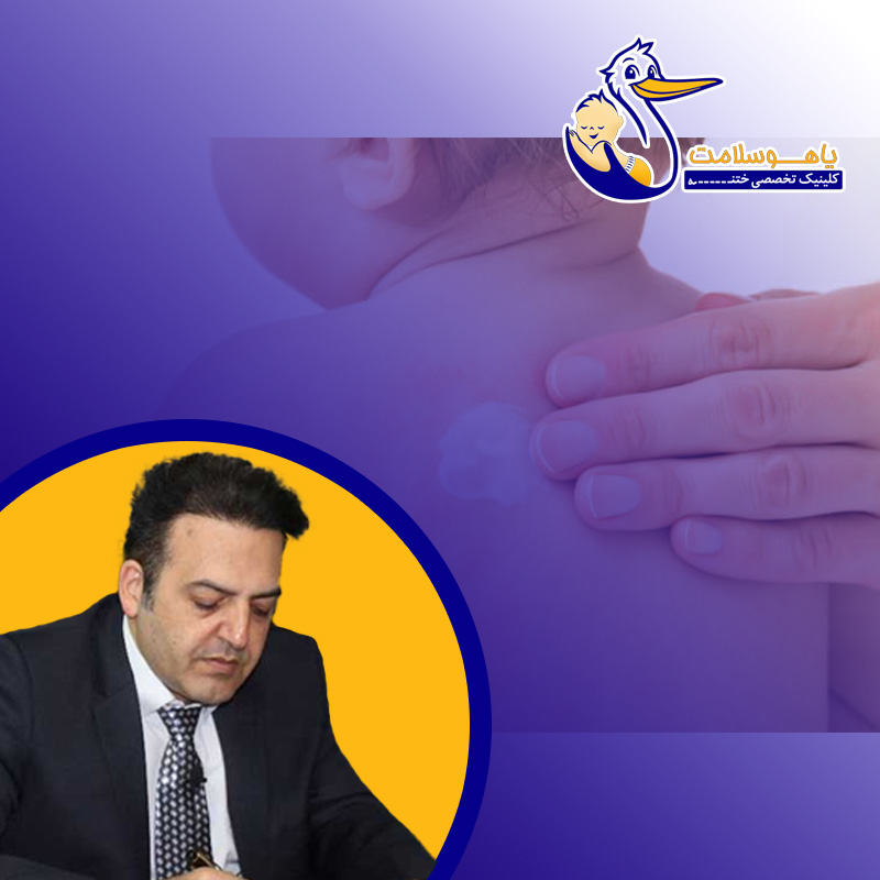 اگزمای کودک