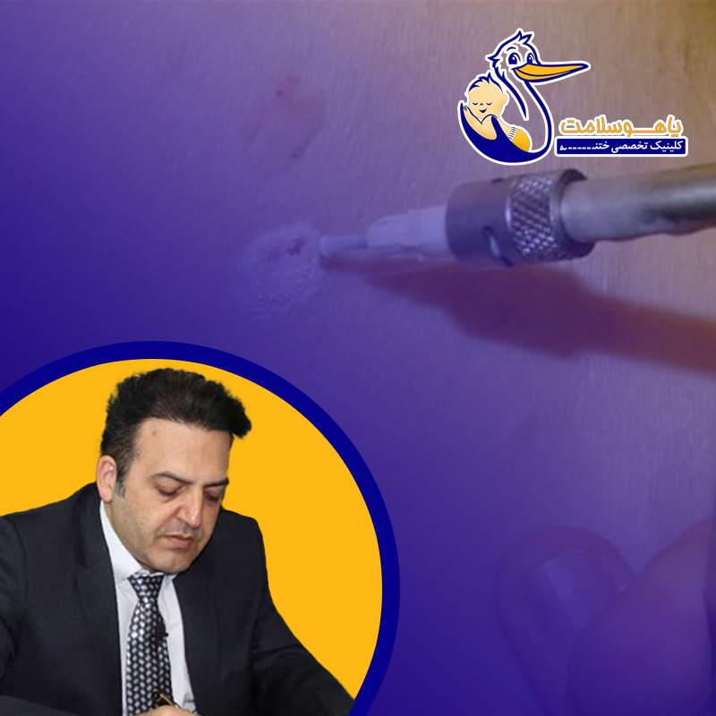 کرایوتراپی زگیل