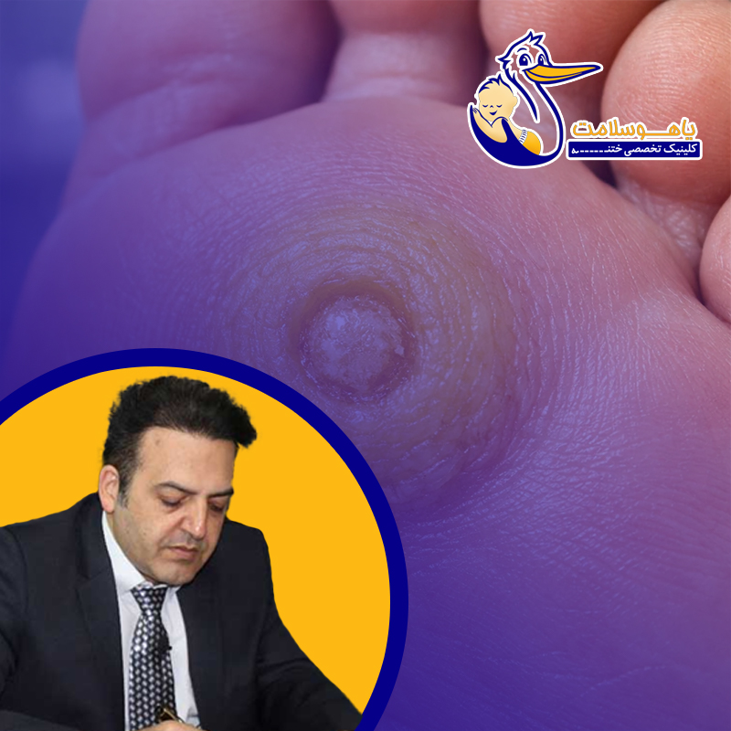 تفاوت-میخچه-سخت-و-نرم-چیست؟-آشنایی-کامل-با-انواع-میخچه