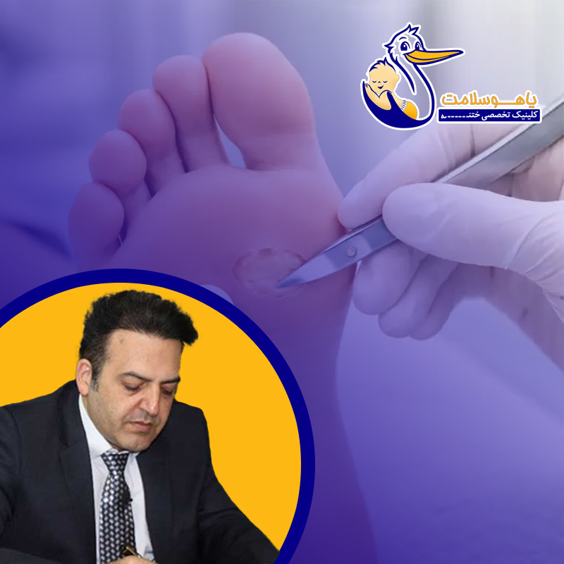 میخچه-کف-پا-چرا-ایجاد-می‌شود؟درمان-میخچه-کف-پا